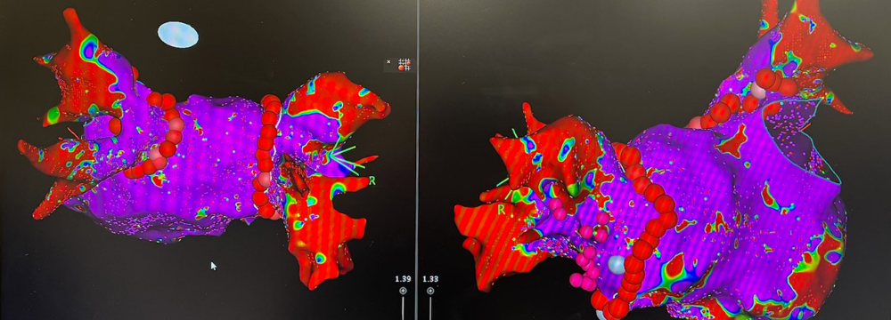 Heart Mapping Technology In The EP Lab   Spotlight On Heart Mapping Technology In Electrophysiology 1 